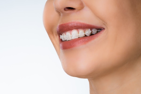 The Impact Of Adult Orthodontics On Your Overall Health