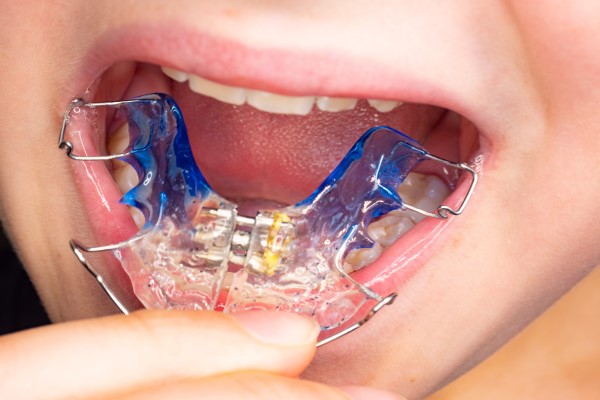 The Role Of Retainers In Orthodontic Treatment: What You Should Know